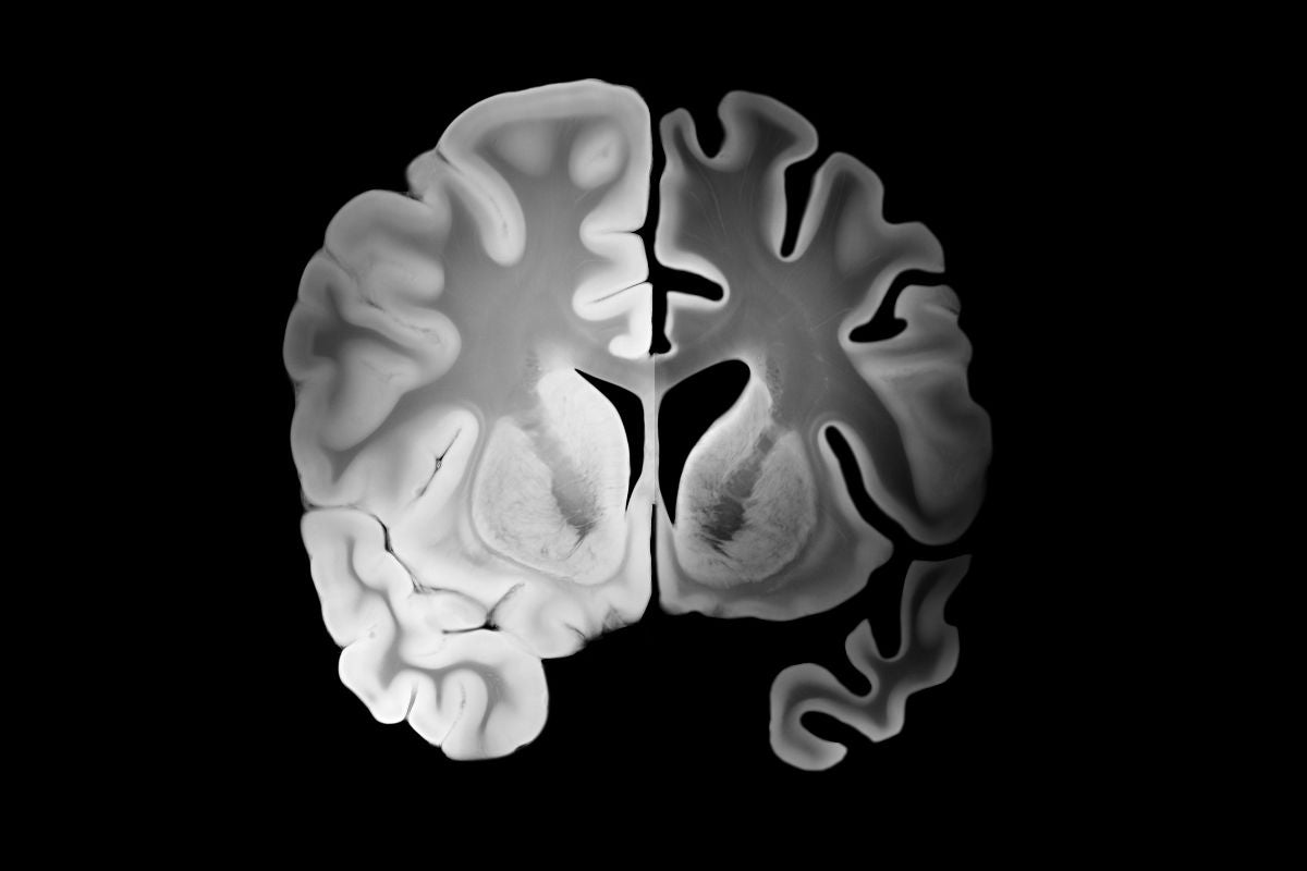 Memoria e invecchiamento cerebrale: i fattori di rischio genetici nelle malattie neurodegenerative come l’Alzheimer