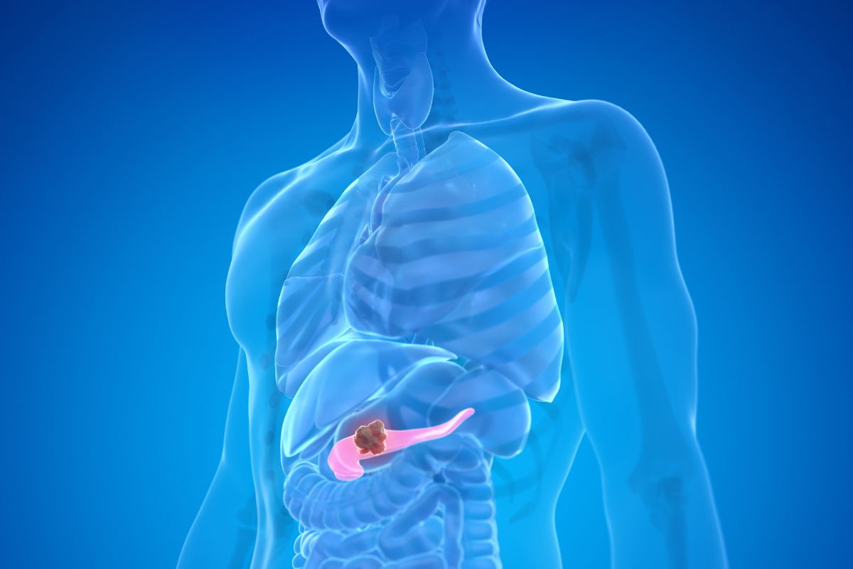 Tumore al pancreas e genetica: conoscere il proprio DNA per una prevenzione consapevole