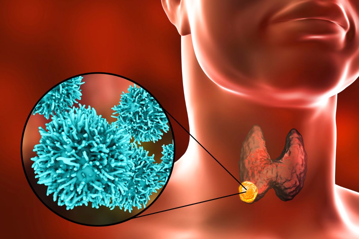 Predisposizione genetica al cancro alla tiroide: comprendere il rischio per agire in tempo